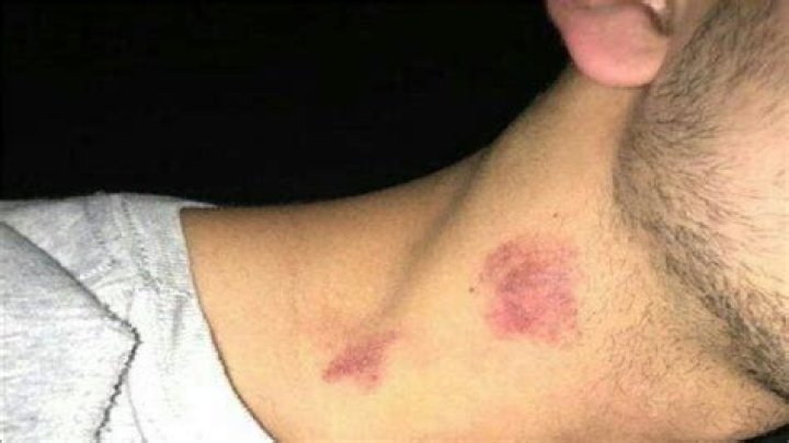 How to Give Yourself a Hickey on Your Own Neck: A Guide