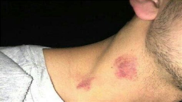 How to Give Yourself a Hickey With a Spoon: A Comprehensive Guide