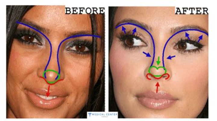 Kim Kardashian's Rhinoplasty Journey: A Comprehensive Guide