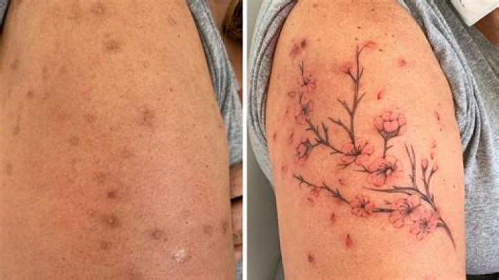 Masterful Tattoo Art: Transforming Scars into Artistic Expressions