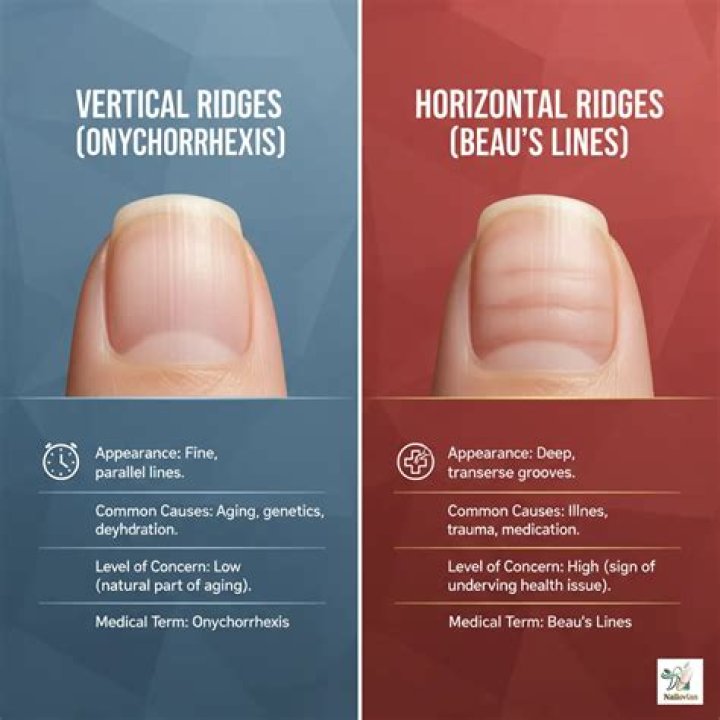 Vertical Lines in Fingernails: Causes, Diagnosis, and Treatment